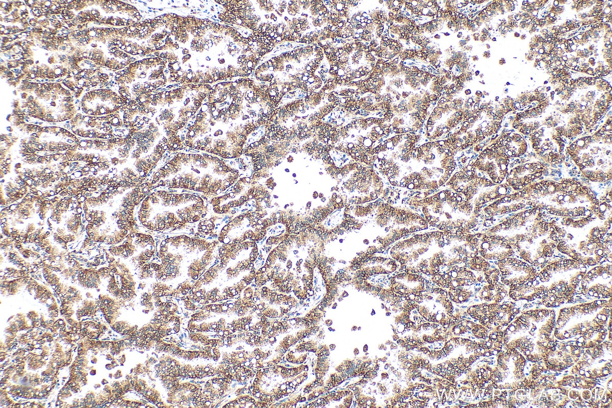 Immunohistochemistry (IHC) staining of human lung cancer tissue using RRBP1 Polyclonal antibody (22015-1-AP)