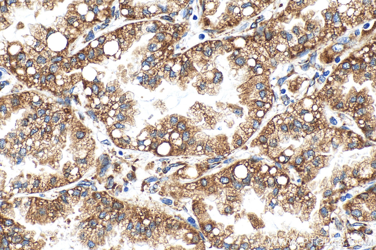 Immunohistochemistry (IHC) staining of human lung cancer tissue using RRBP1 Polyclonal antibody (22015-1-AP)