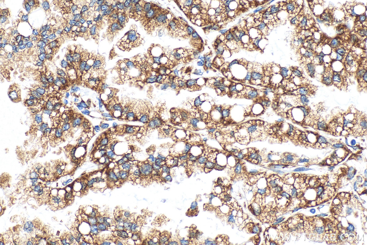 IHC staining of human lung cancer using 22015-1-AP