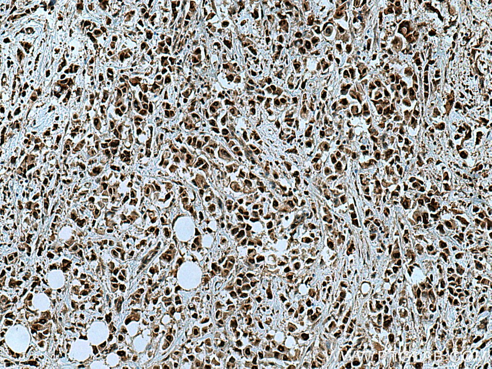 Immunohistochemistry (IHC) staining of human breast cancer tissue using RREB1 Polyclonal antibody (27706-1-AP)