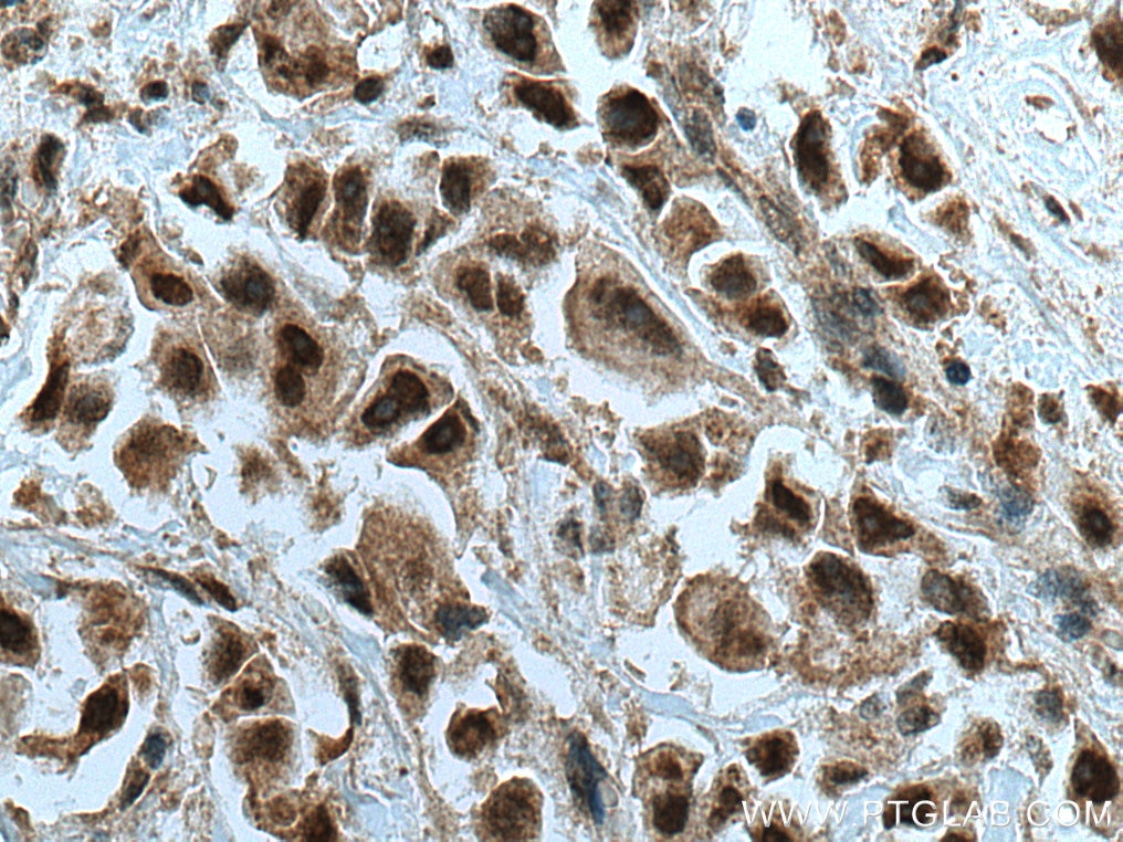 Immunohistochemistry (IHC) staining of human breast cancer tissue using RREB1 Polyclonal antibody (27706-1-AP)