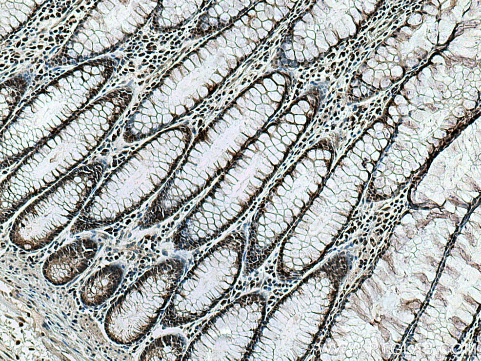 Immunohistochemistry (IHC) staining of human colon cancer tissue using RREB1 Polyclonal antibody (27706-1-AP)