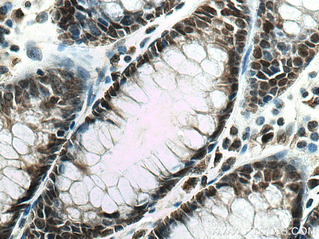 Immunohistochemistry (IHC) staining of human colon cancer tissue using RREB1 Polyclonal antibody (27706-1-AP)