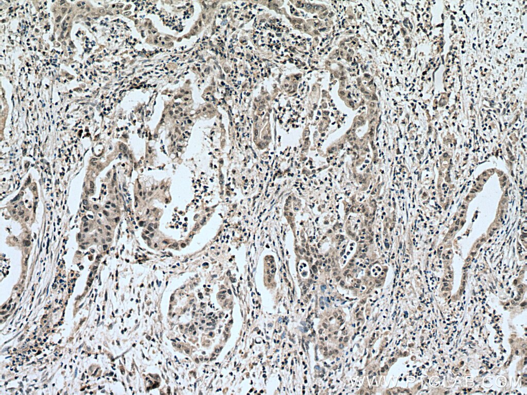 Immunohistochemistry (IHC) staining of human pancreas cancer tissue using RREB1-Specific Polyclonal antibody (20280-1-AP)