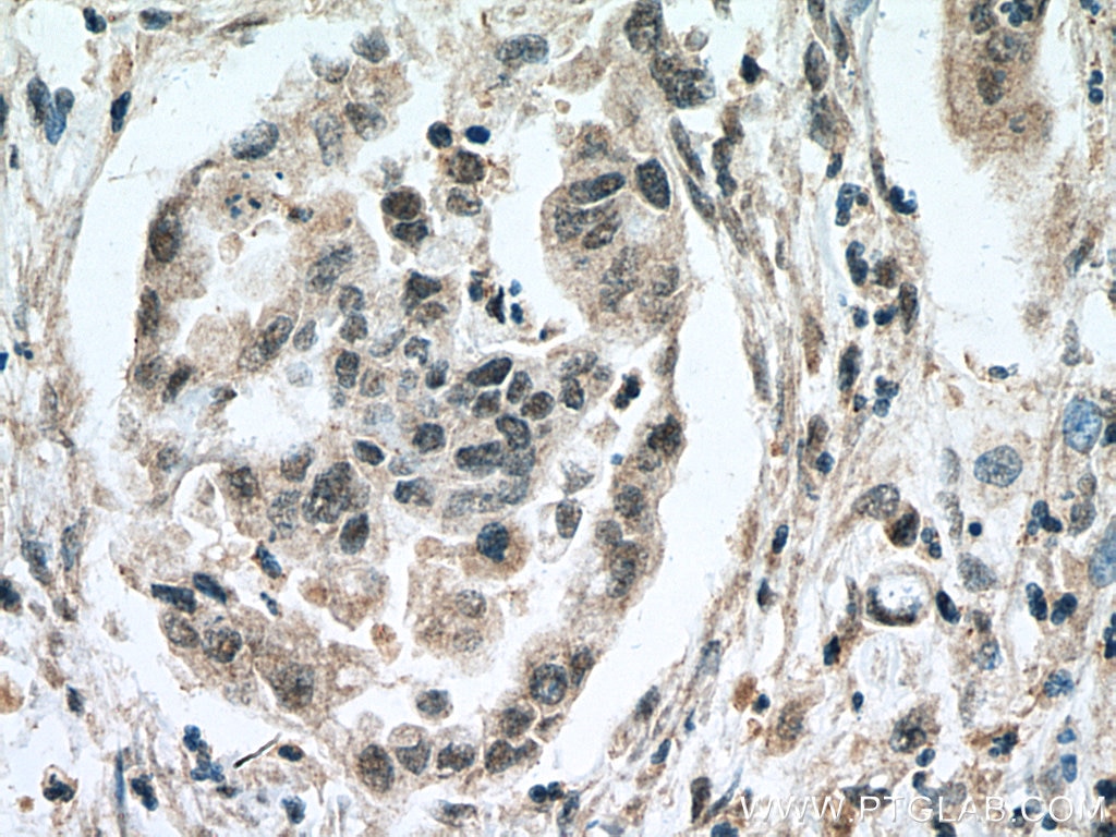 Immunohistochemistry (IHC) staining of human pancreas cancer tissue using RREB1-Specific Polyclonal antibody (20280-1-AP)