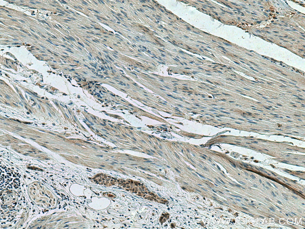 Immunohistochemistry (IHC) staining of human urothelial carcinoma tissue using RREB1-Specific Polyclonal antibody (20280-1-AP)