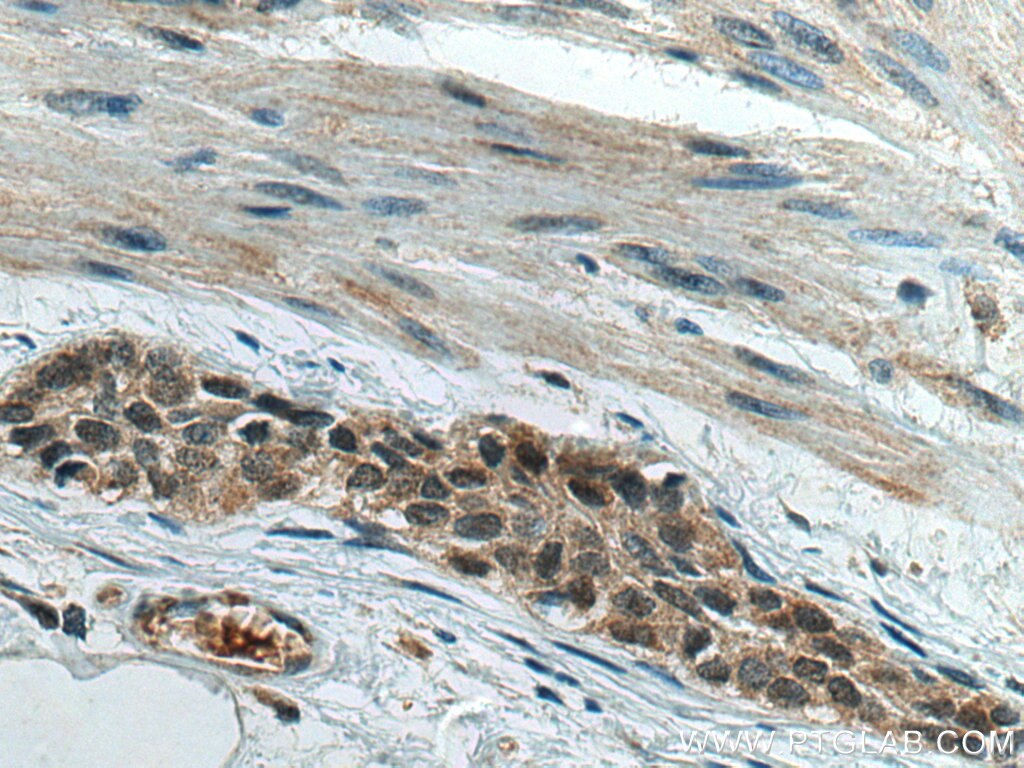 Immunohistochemistry (IHC) staining of human urothelial carcinoma tissue using RREB1-Specific Polyclonal antibody (20280-1-AP)