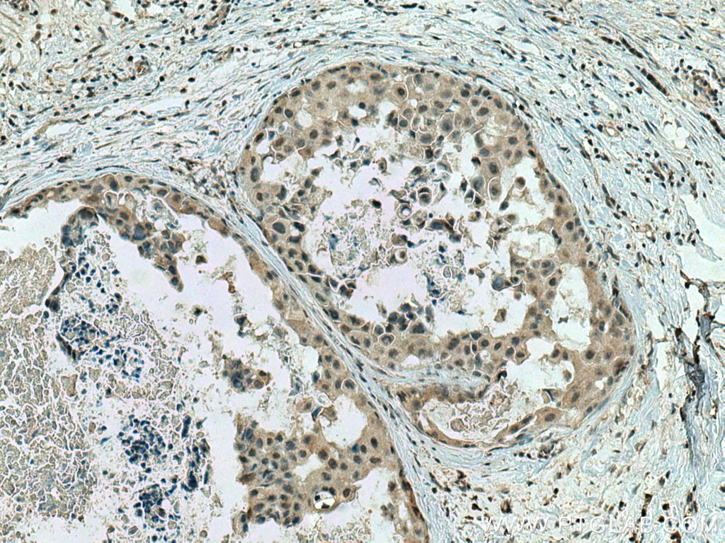 Immunohistochemistry (IHC) staining of human breast cancer tissue using RREB1-Specific Polyclonal antibody (20280-1-AP)