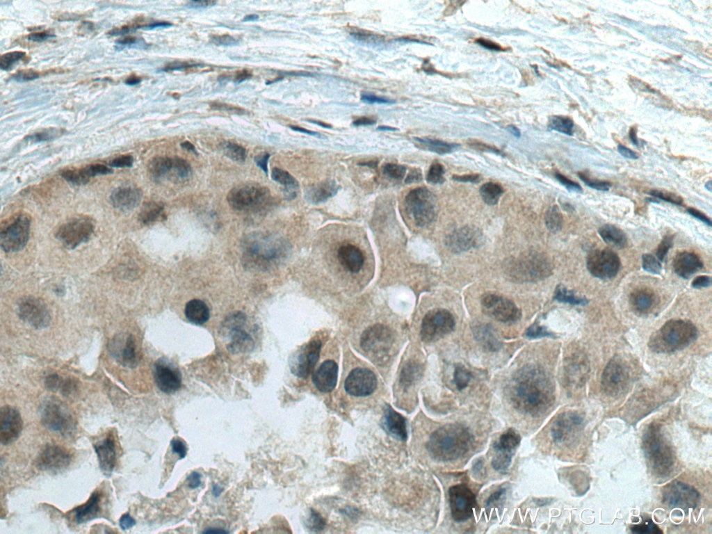 Immunohistochemistry (IHC) staining of human breast cancer tissue using RREB1-Specific Polyclonal antibody (20280-1-AP)