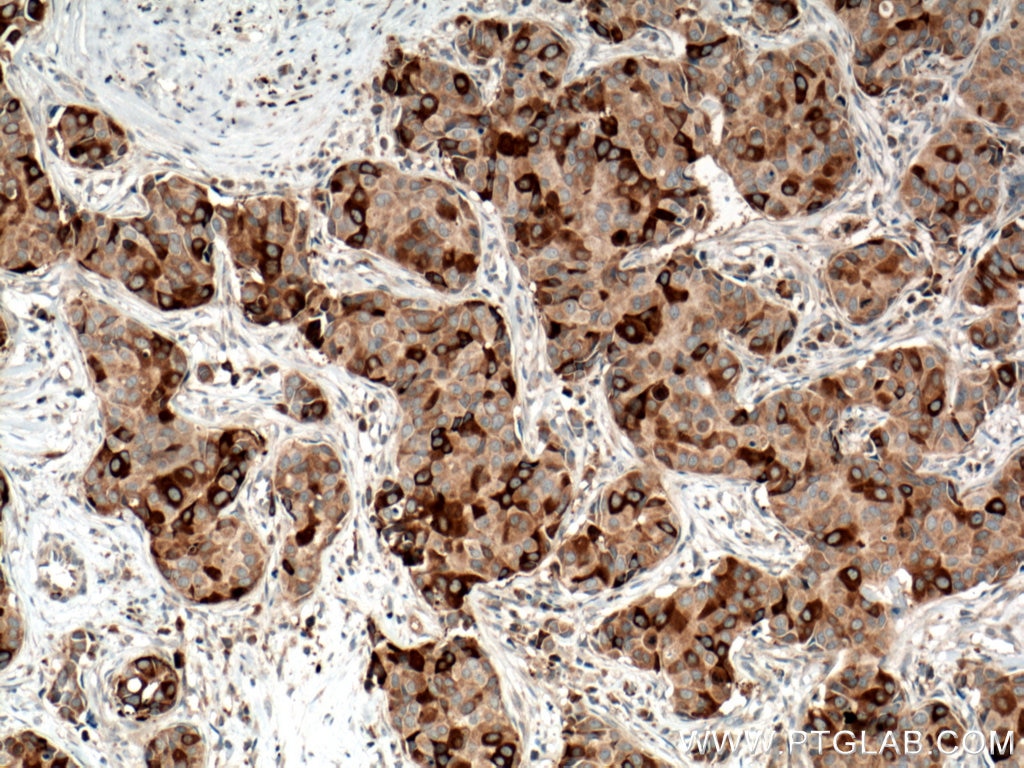 Immunohistochemistry (IHC) staining of human breast cancer tissue using RRM1 Polyclonal antibody (10526-1-AP)