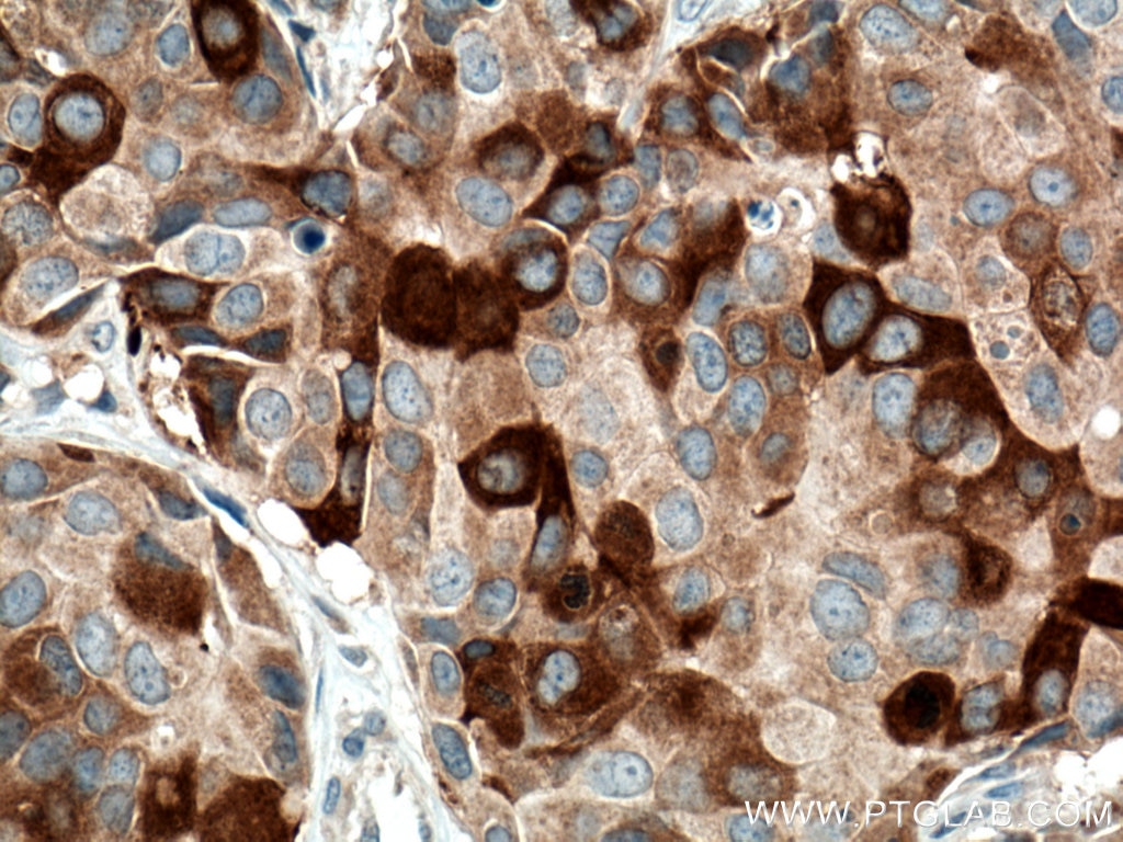 Immunohistochemistry (IHC) staining of human breast cancer tissue using RRM1 Polyclonal antibody (10526-1-AP)