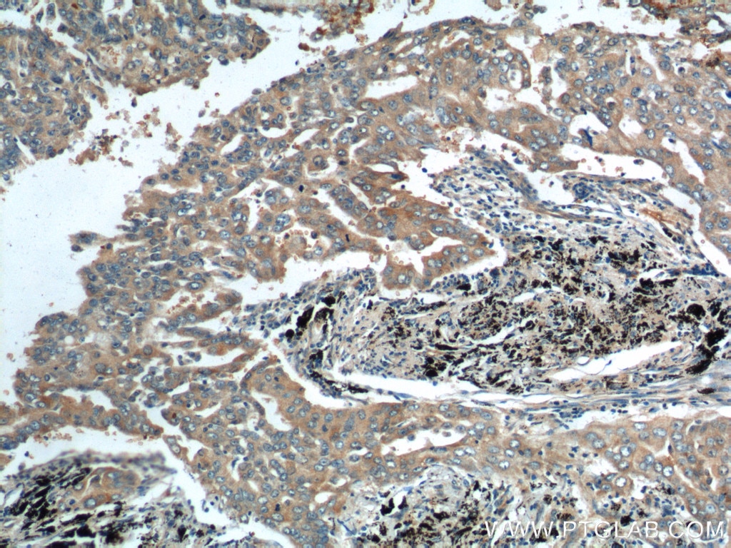 IHC staining of human lung cancer using 10526-1-AP