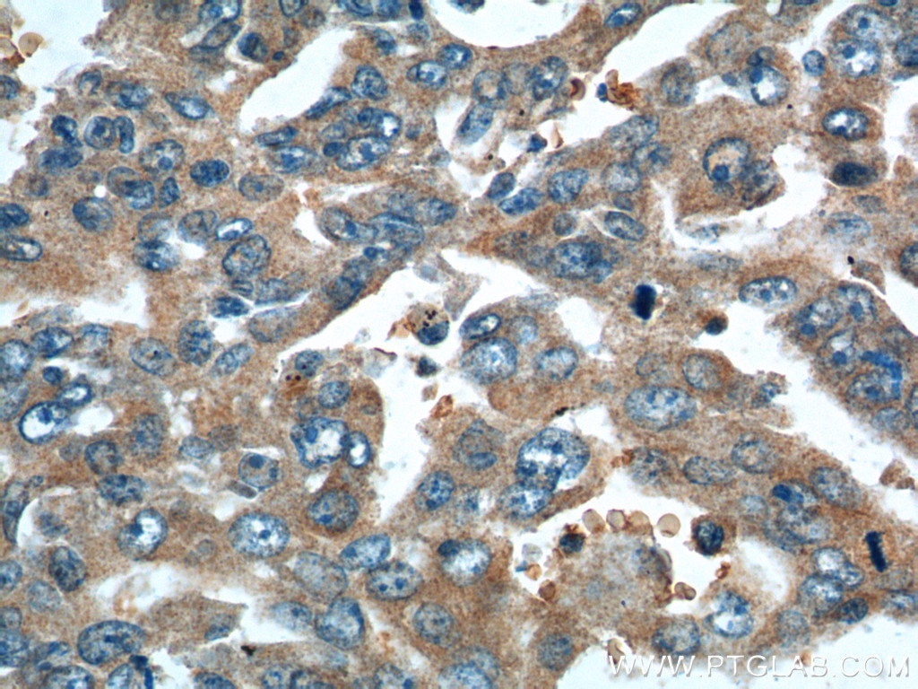 Immunohistochemistry (IHC) staining of human lung cancer tissue using RRM1 Polyclonal antibody (10526-1-AP)