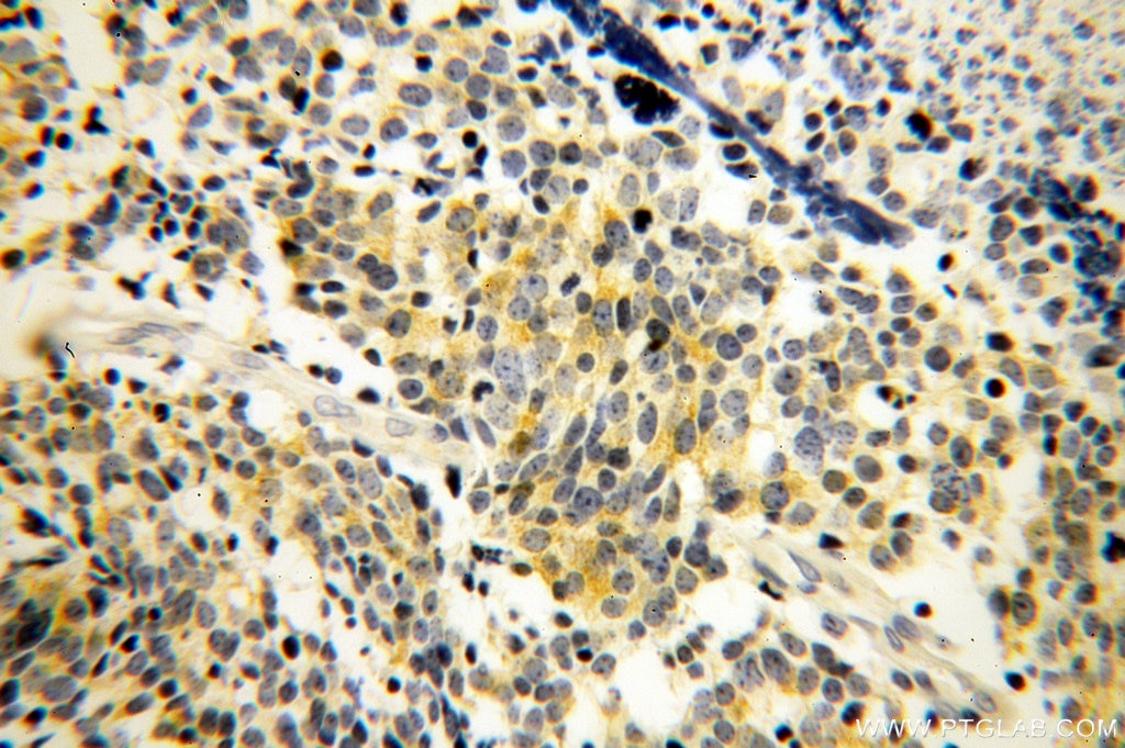 Immunohistochemistry (IHC) staining of human lung cancer tissue using RRM1 Monoclonal antibody (60073-1-Ig)