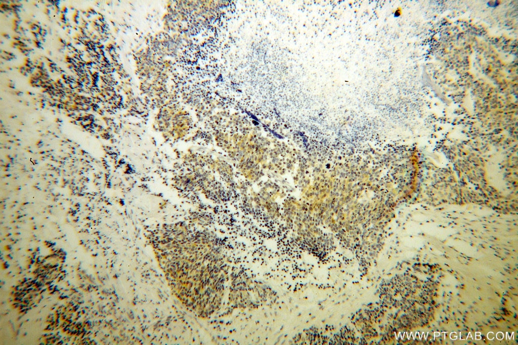 IHC staining of human lung cancer using 60073-1-Ig