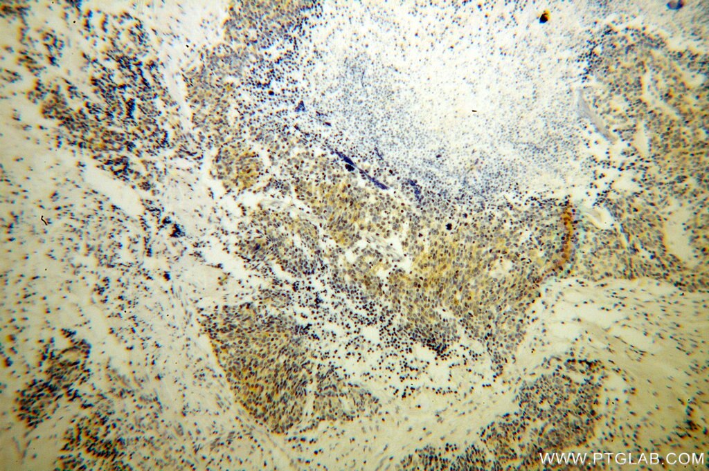 Immunohistochemistry (IHC) staining of human lung cancer tissue using RRM1 Monoclonal antibody (60073-1-Ig)