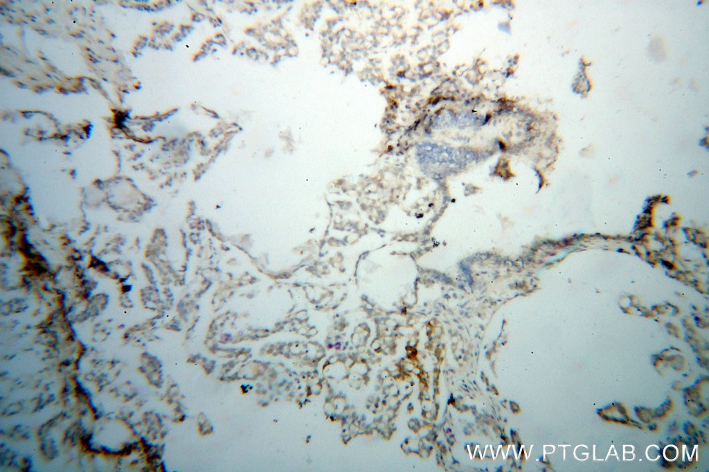Immunohistochemistry (IHC) staining of human ovary tumor tissue using RRM1 Monoclonal antibody (60073-1-Ig)