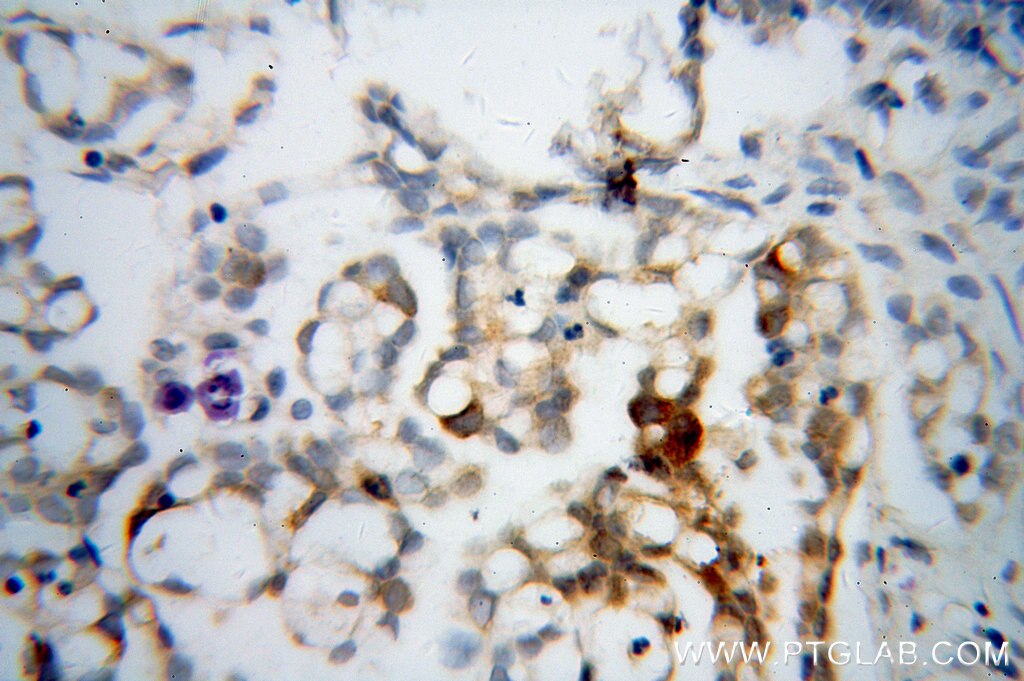 Immunohistochemistry (IHC) staining of human ovary tumor tissue using RRM1 Monoclonal antibody (60073-1-Ig)