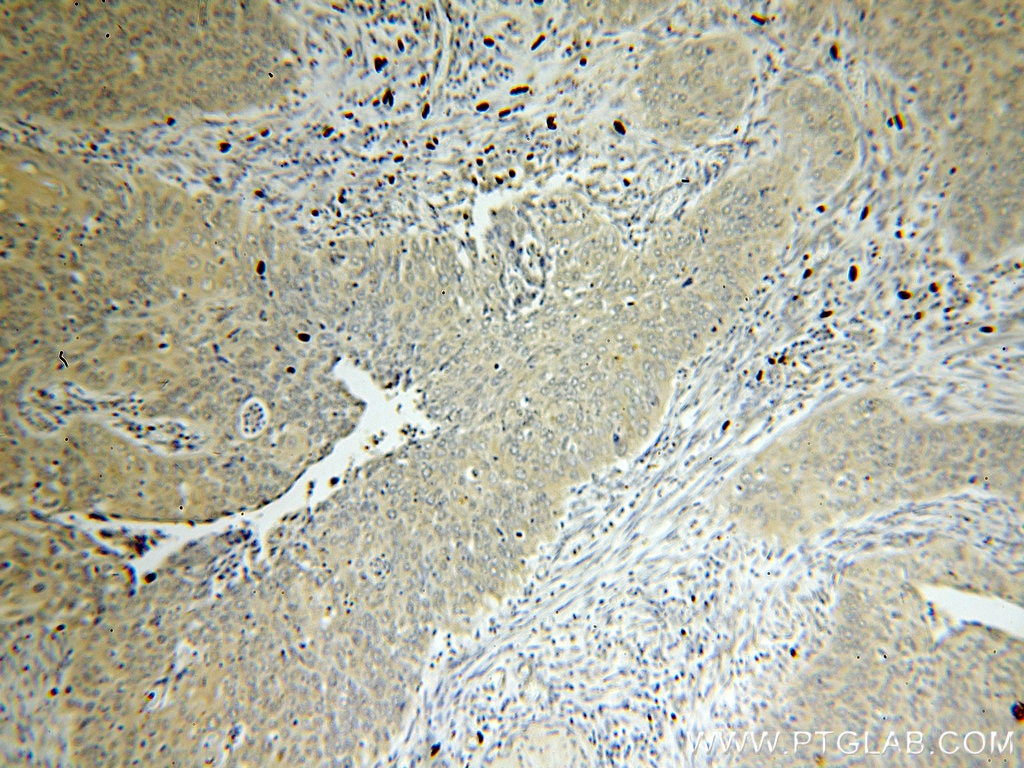 Immunohistochemistry (IHC) staining of human cervical cancer tissue using RRM1 Monoclonal antibody (60073-1-Ig)