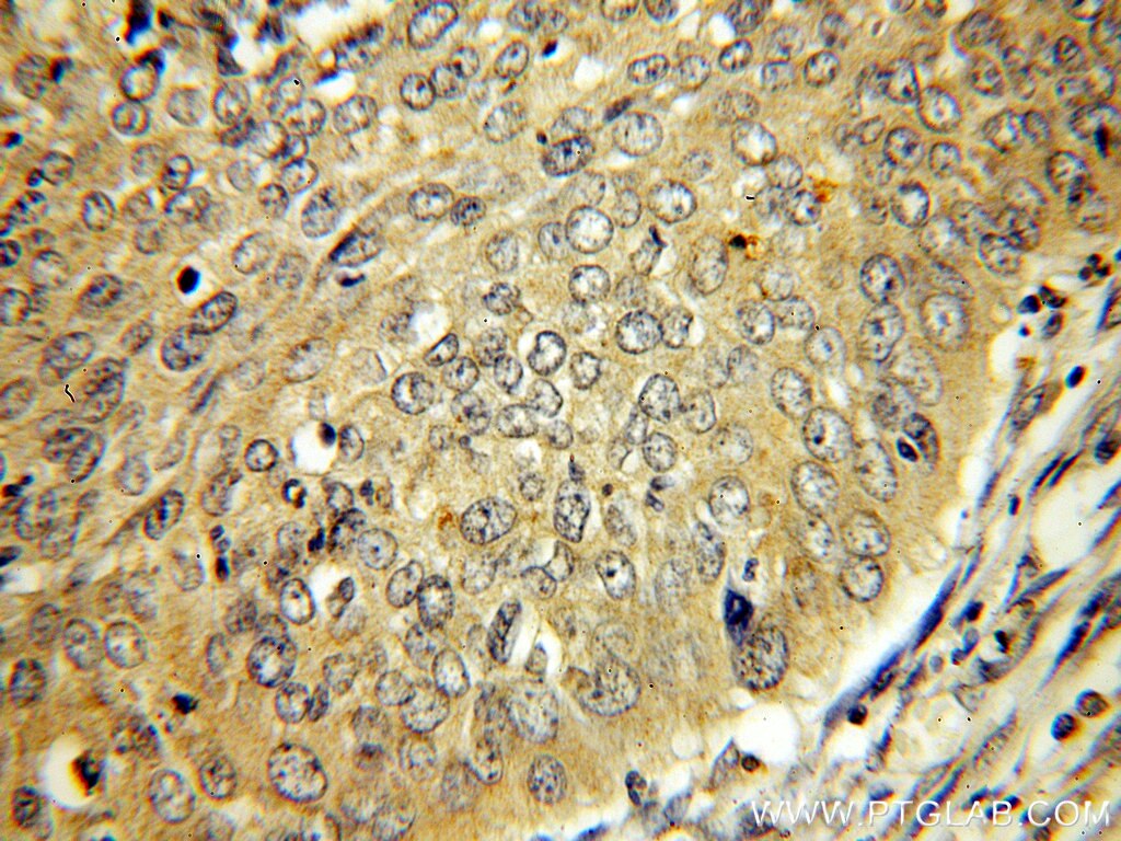 Immunohistochemistry (IHC) staining of human cervical cancer tissue using RRM1 Monoclonal antibody (60073-1-Ig)