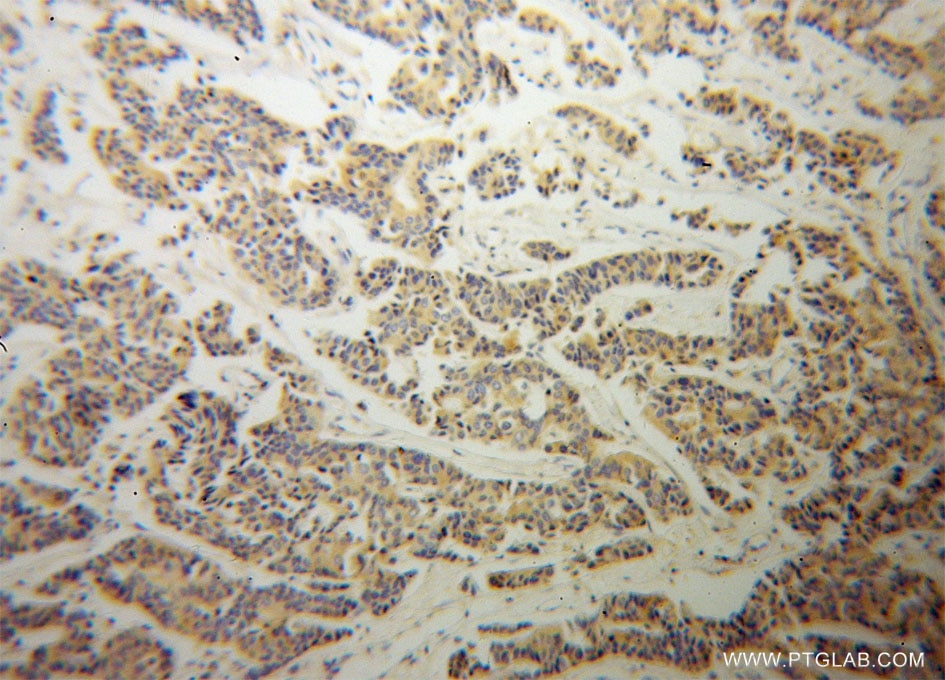 Immunohistochemistry (IHC) staining of human breast cancer tissue using RRM1 Monoclonal antibody (60073-1-Ig)