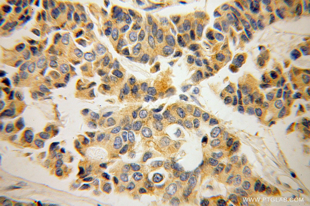 IHC staining of human breast cancer using 60073-1-Ig
