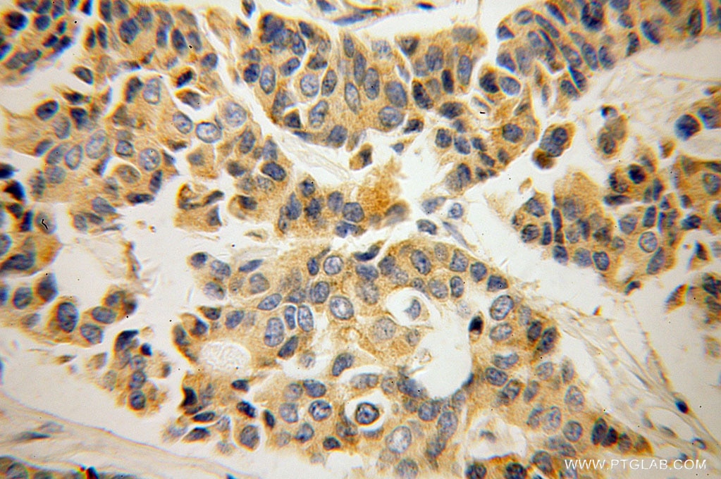 Immunohistochemistry (IHC) staining of human breast cancer tissue using RRM1 Monoclonal antibody (60073-1-Ig)