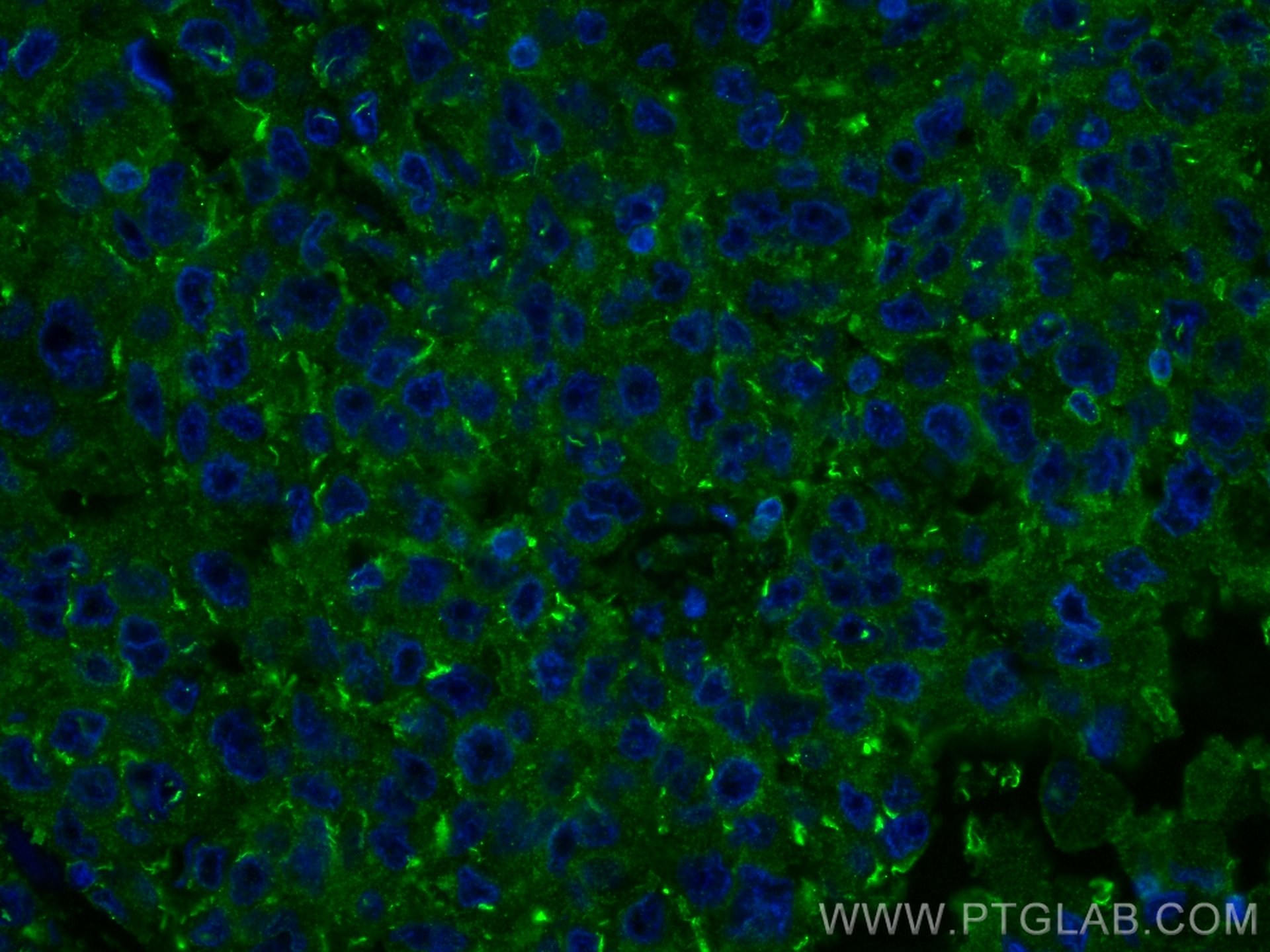 Immunofluorescence (IF) / fluorescent staining of human breast cancer tissue using RRM1 Monoclonal antibody (60073-2-Ig)