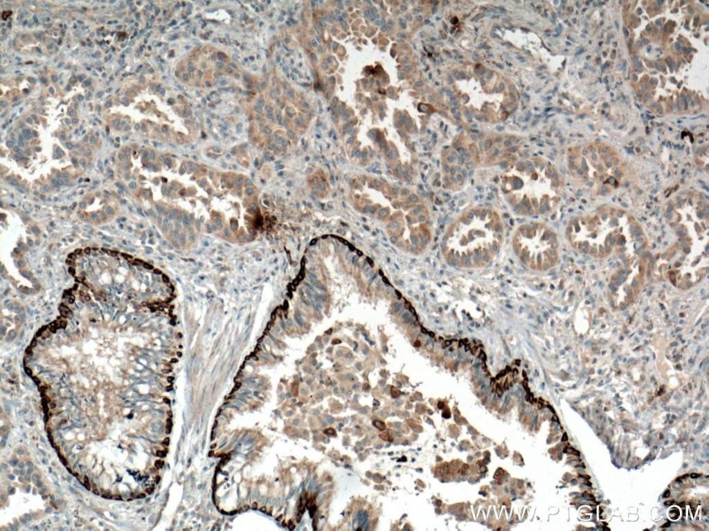 Immunohistochemistry (IHC) staining of human lung cancer tissue using RRM1 Monoclonal antibody (60073-2-Ig)