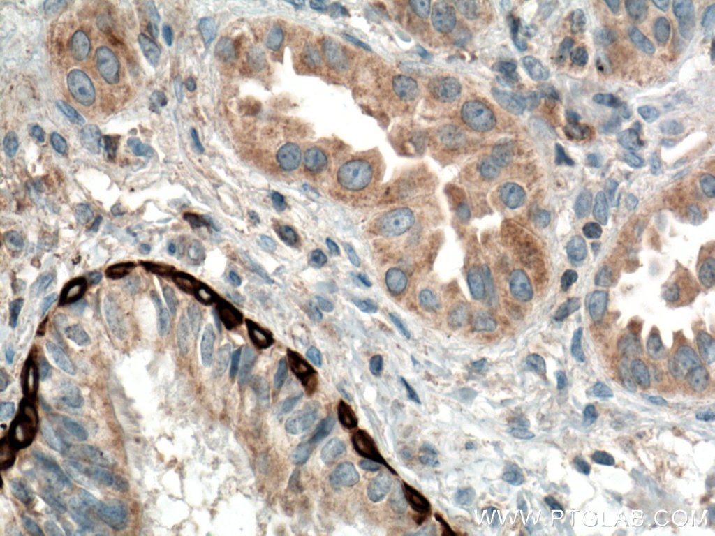 Immunohistochemistry (IHC) staining of human lung cancer tissue using RRM1 Monoclonal antibody (60073-2-Ig)