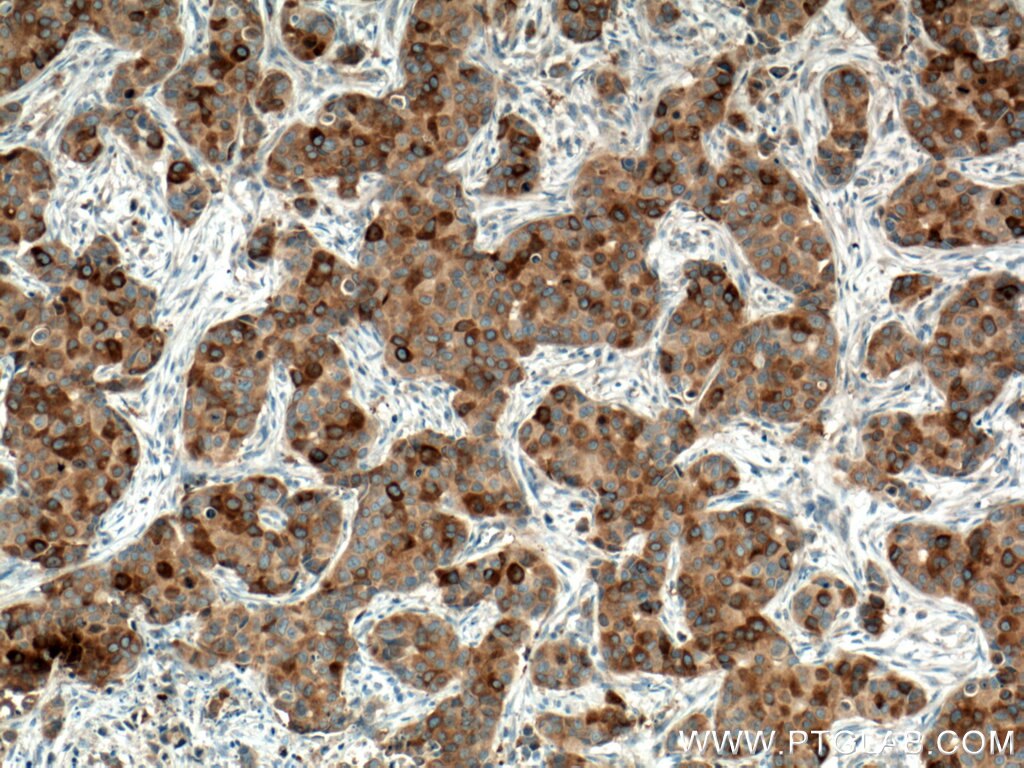Immunohistochemistry (IHC) staining of human breast cancer tissue using RRM1 Monoclonal antibody (60073-2-Ig)