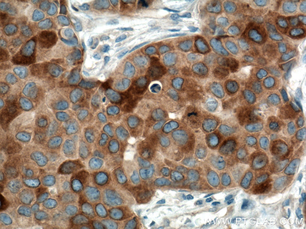 Immunohistochemistry (IHC) staining of human breast cancer tissue using RRM1 Monoclonal antibody (60073-2-Ig)