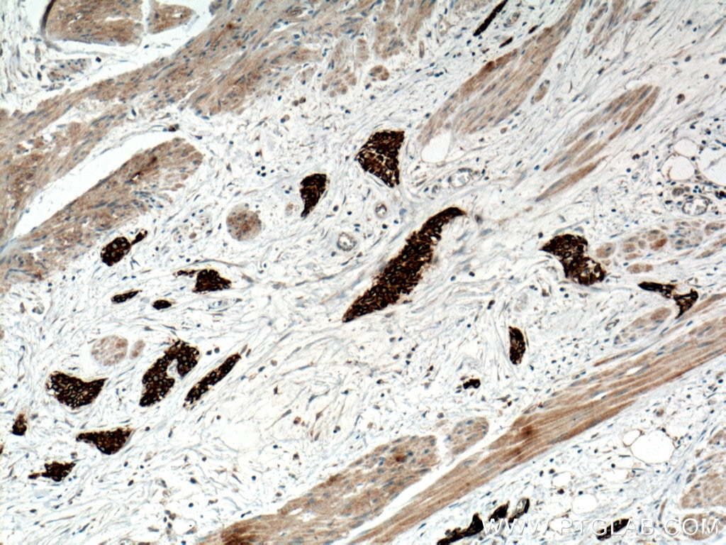 Immunohistochemistry (IHC) staining of human urothelial carcinoma tissue using RRM1 Monoclonal antibody (60073-2-Ig)
