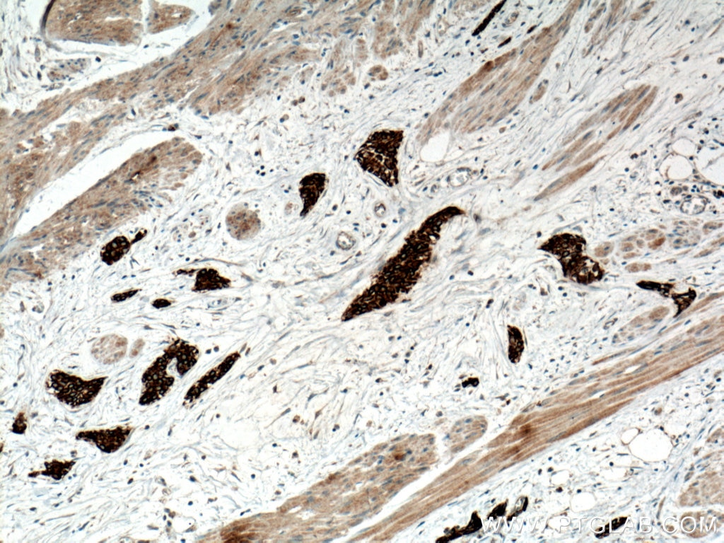 IHC staining of human urothelial carcinoma using 60073-2-Ig