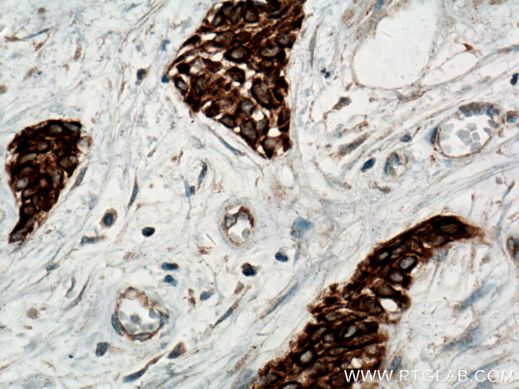IHC staining of human urothelial carcinoma using 60073-2-Ig