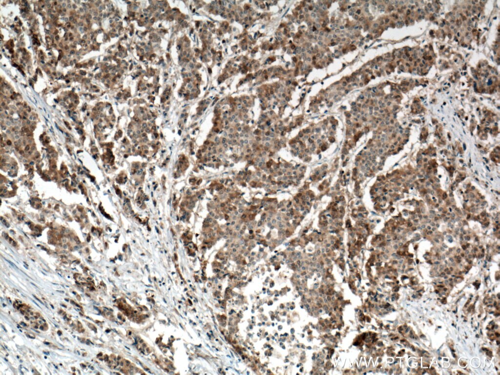 Immunohistochemistry (IHC) staining of human colon cancer tissue using RRM1 Monoclonal antibody (60073-2-Ig)