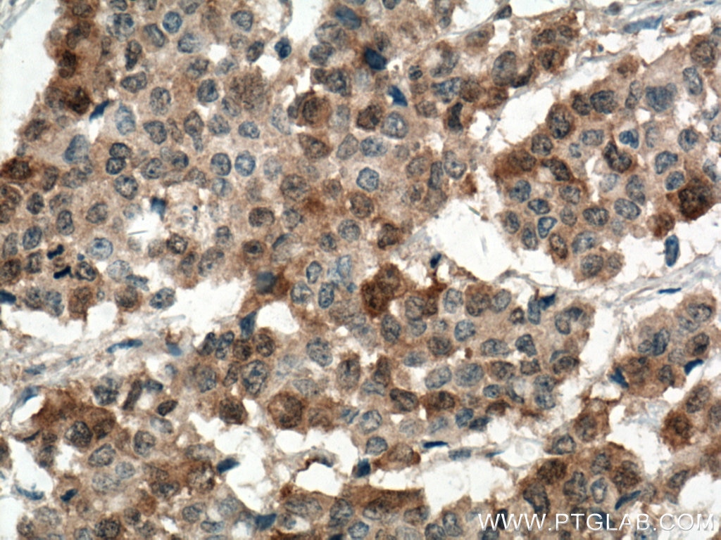 Immunohistochemistry (IHC) staining of human colon cancer tissue using RRM1 Monoclonal antibody (60073-2-Ig)