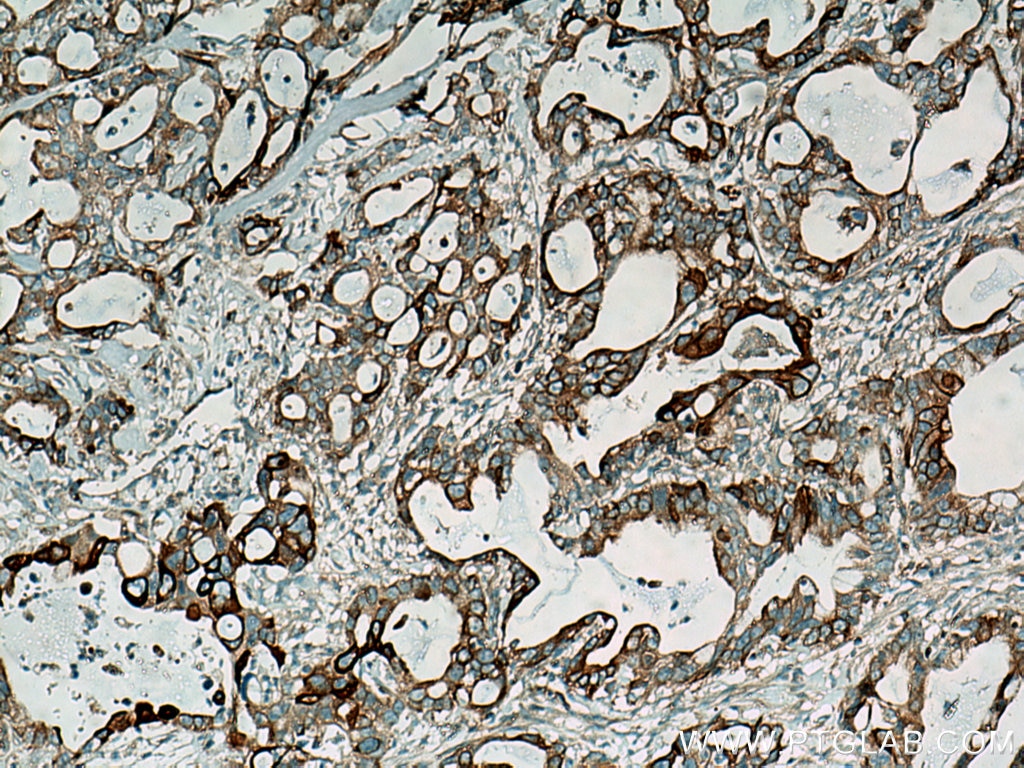 Immunohistochemistry (IHC) staining of human pancreas cancer tissue using RRM1 Monoclonal antibody (60073-2-Ig)