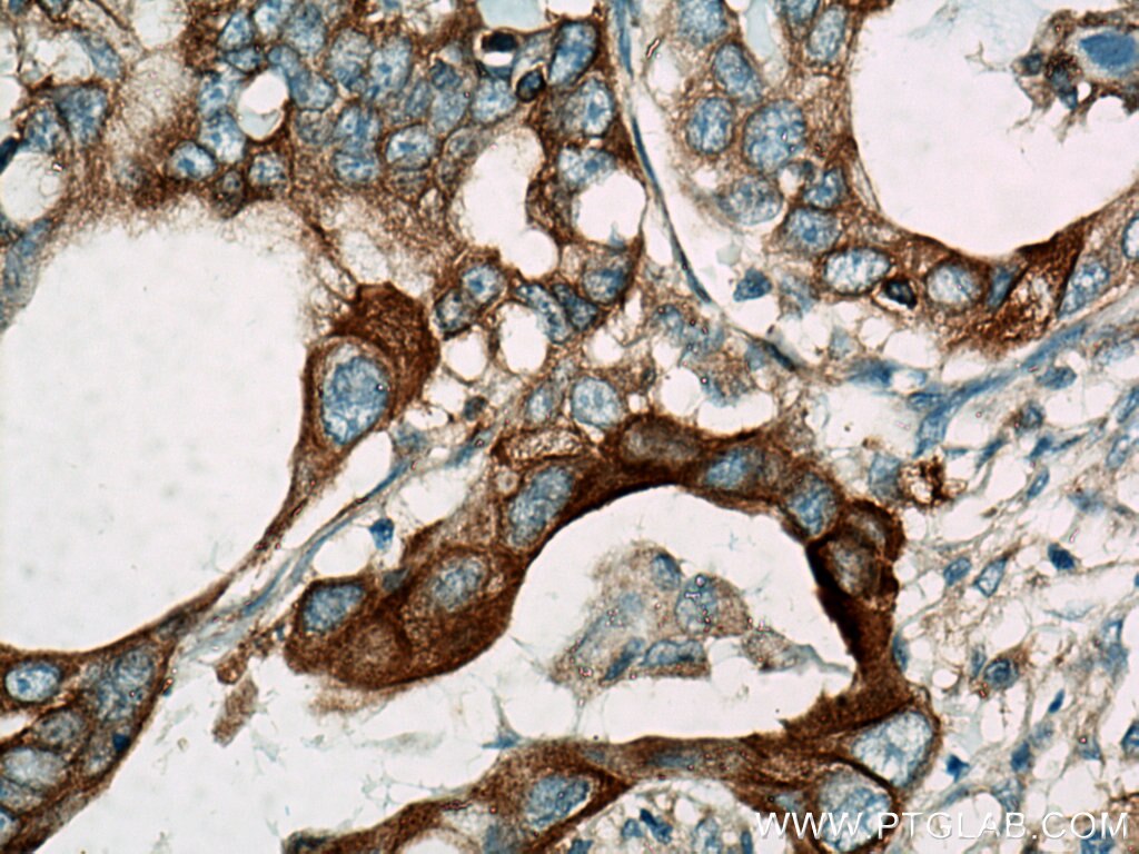 Immunohistochemistry (IHC) staining of human pancreas cancer tissue using RRM1 Monoclonal antibody (60073-2-Ig)