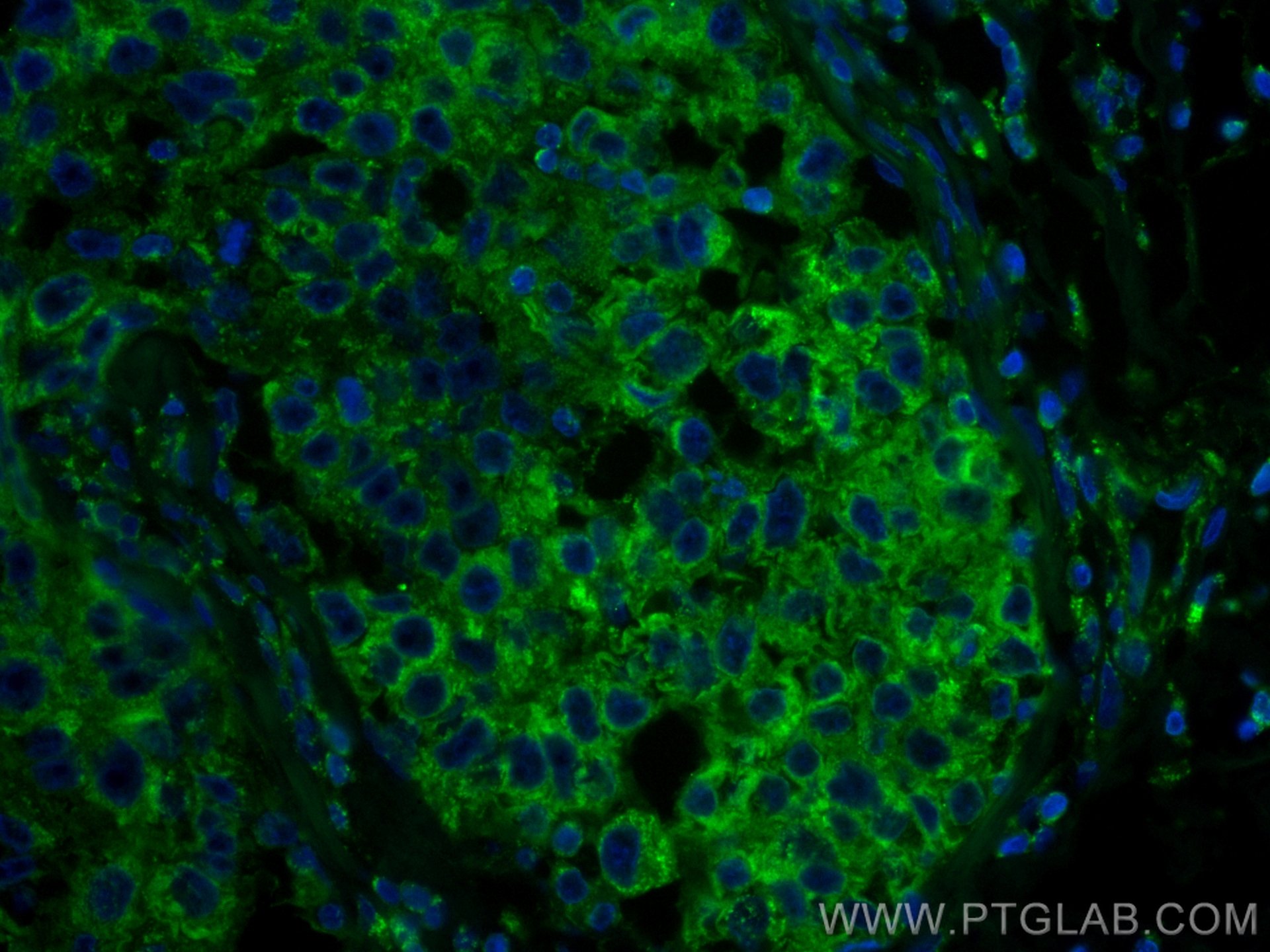 Immunofluorescence (IF) / fluorescent staining of human breast cancer tissue using CoraLite® Plus 488-conjugated RRM1 Monoclonal anti (CL488-60073)