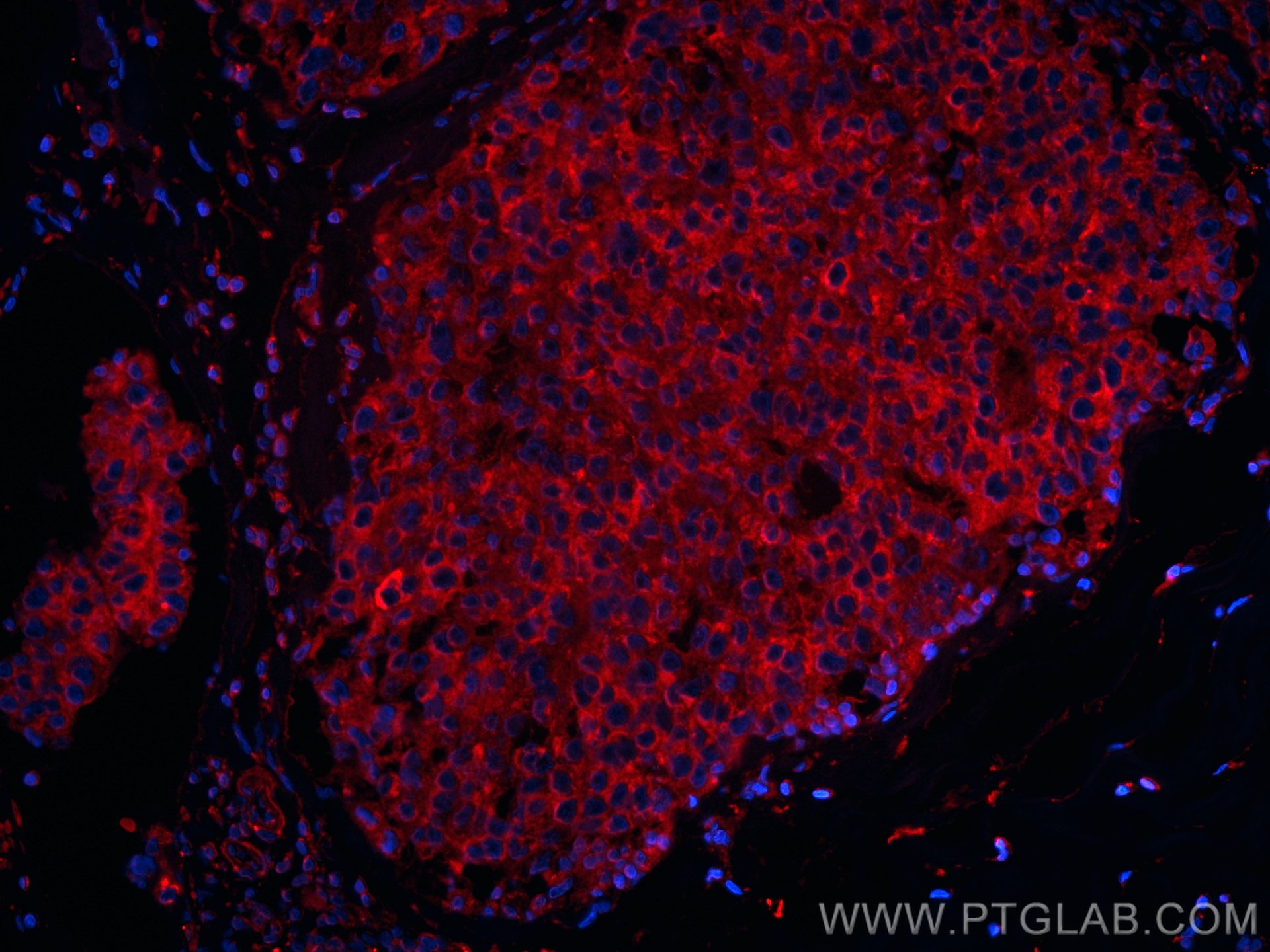 IF Staining of human breast cancer using CL594-60073
