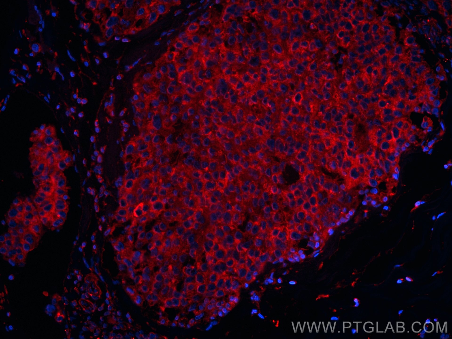 Immunofluorescence (IF) / fluorescent staining of human breast cancer tissue using CoraLite®594-conjugated RRM1 Monoclonal antibody (CL594-60073)