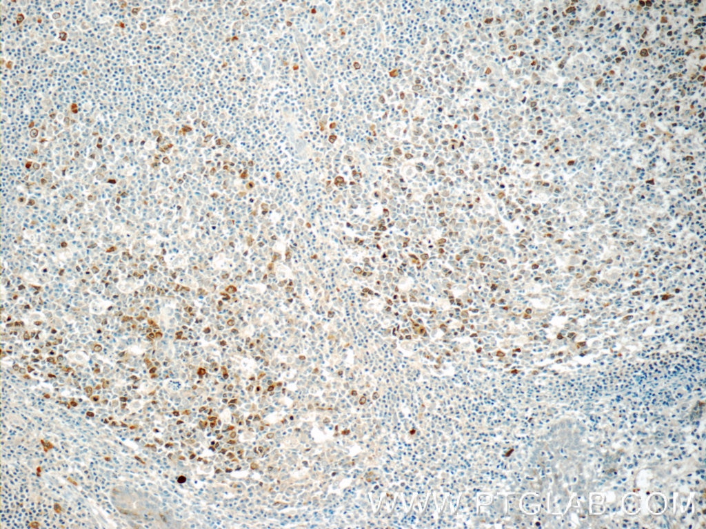 Immunohistochemistry (IHC) staining of human tonsillitis tissue using RRM2 Polyclonal antibody (11661-1-AP)