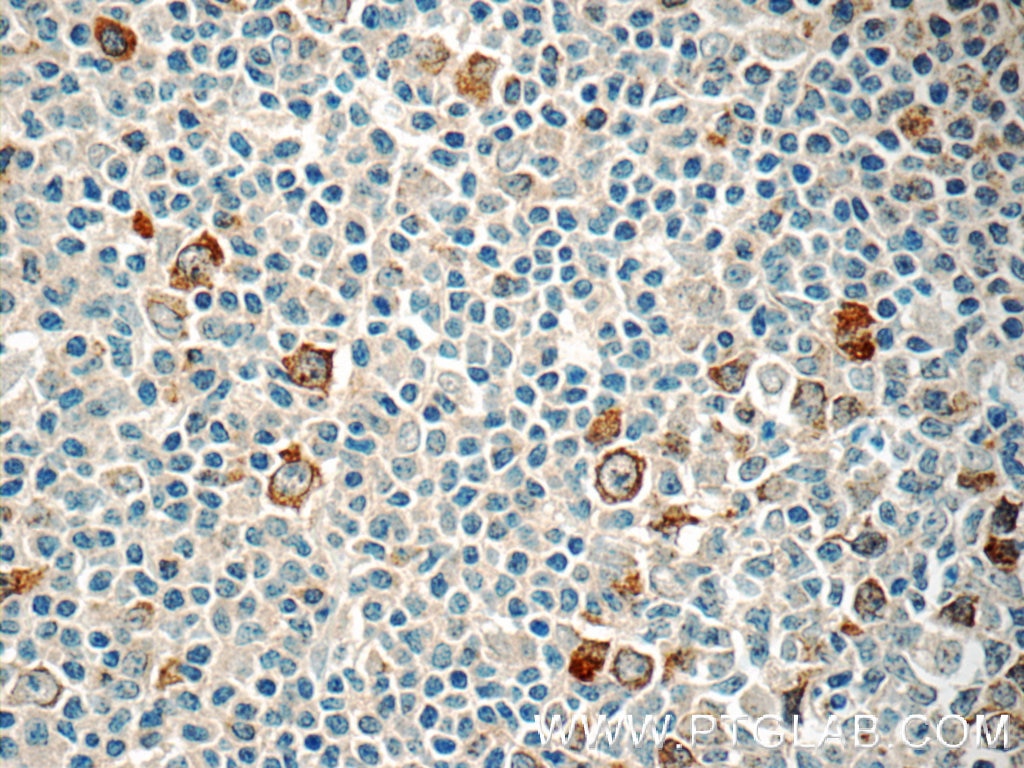 IHC staining of human tonsillitis using 11661-1-AP