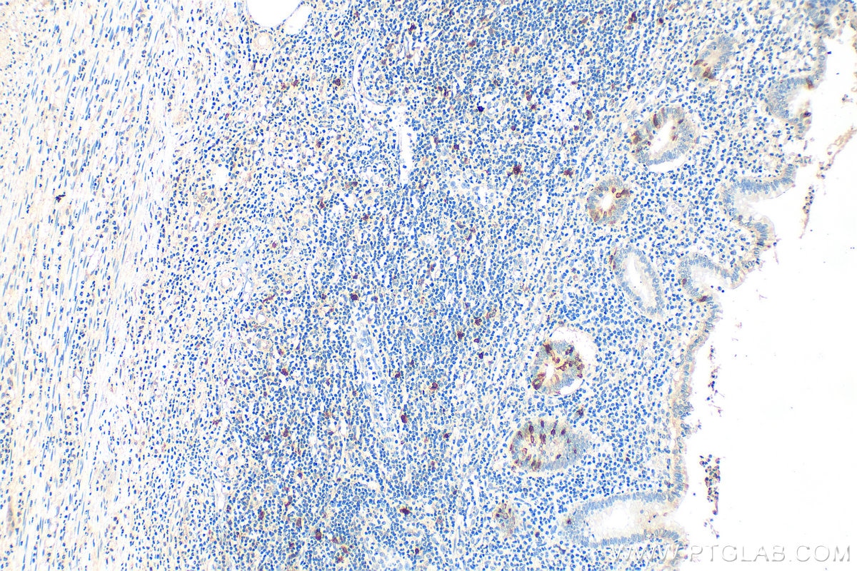 Immunohistochemistry (IHC) staining of human appendicitis tissue using RRM2 Polyclonal antibody (11661-1-AP)