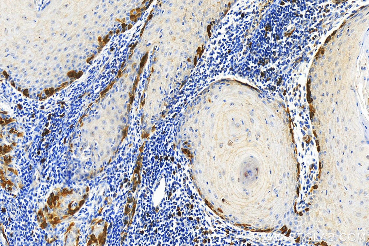 Immunohistochemistry (IHC) staining of human skin cancer tissue using RRM2 Monoclonal antibody (67006-1-Ig)