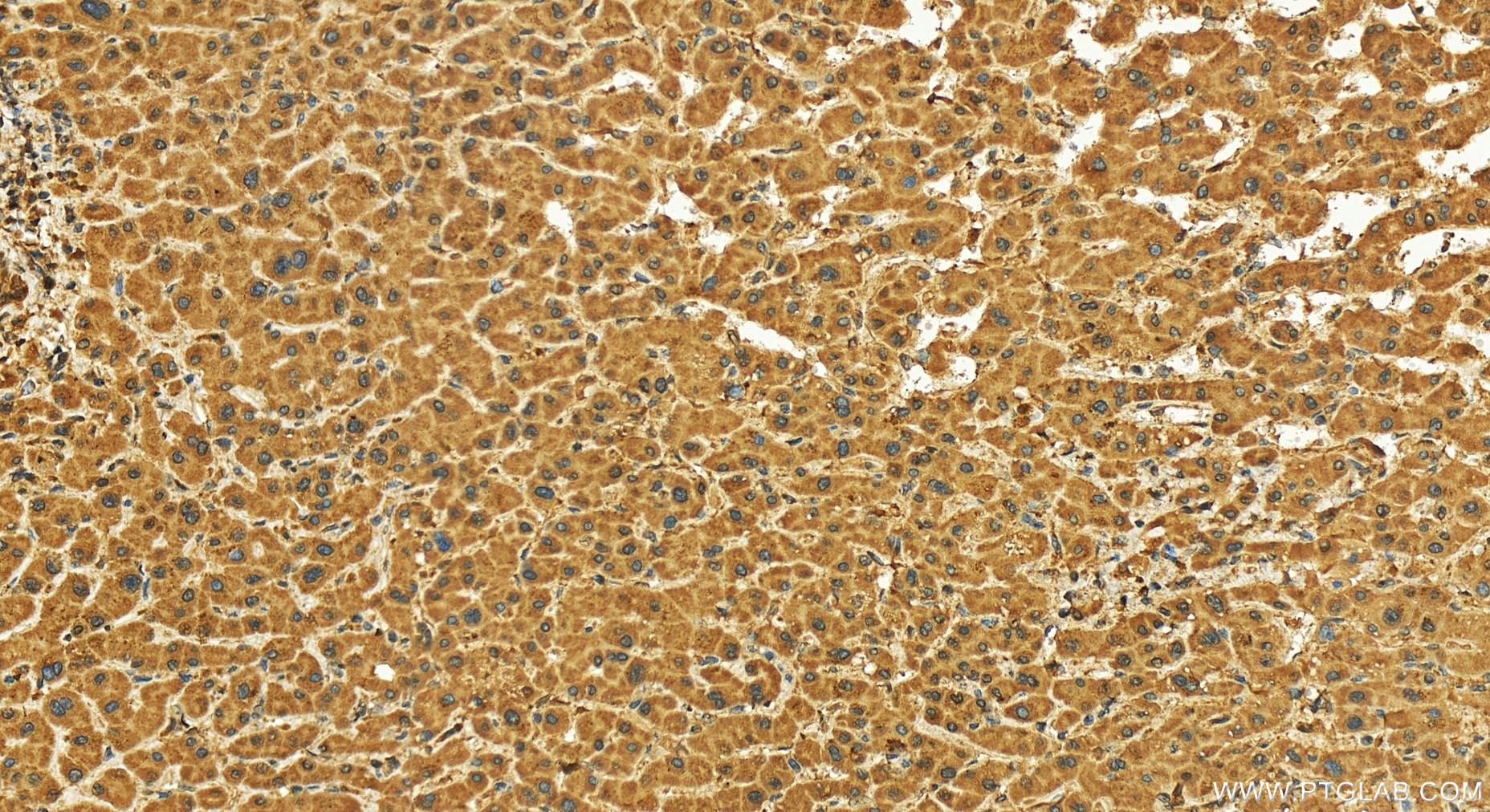 Immunohistochemistry (IHC) staining of human intrahepatic cholangiocarcinoma tissue using RRP1B Polyclonal antibody (27723-1-AP)