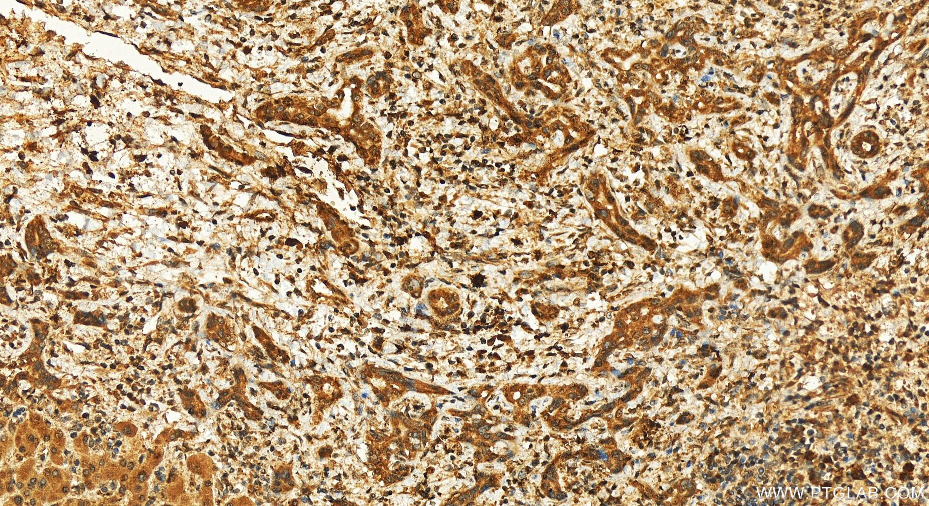 Immunohistochemistry (IHC) staining of human intrahepatic cholangiocarcinoma tissue using RRP1B Polyclonal antibody (27723-1-AP)