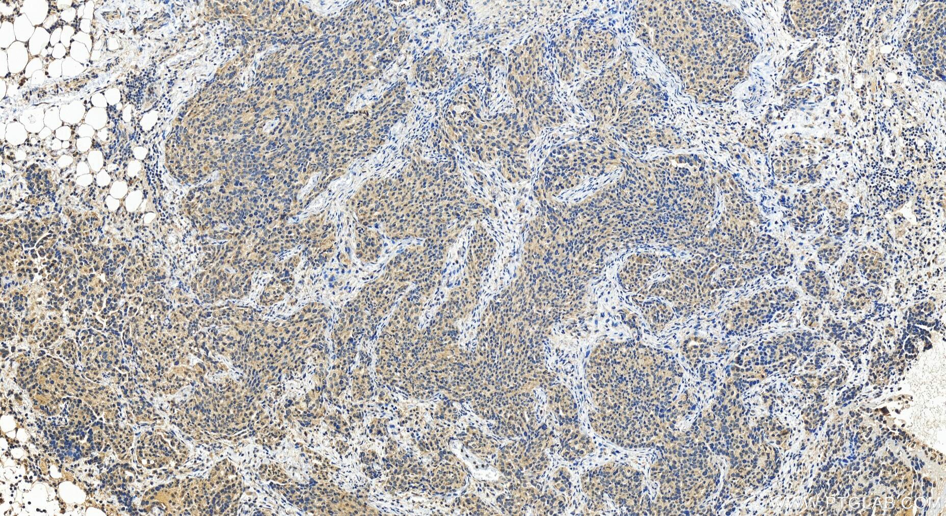 Immunohistochemistry (IHC) staining of human ovary cancer tissue using RRP1B Polyclonal antibody (27723-1-AP)