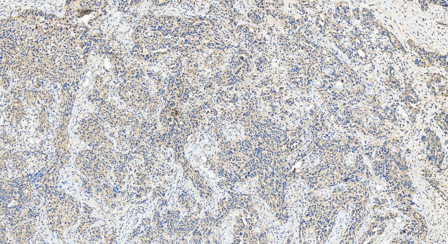 Immunohistochemistry (IHC) staining of human ovary cancer tissue using RRP1B Polyclonal antibody (27723-1-AP)